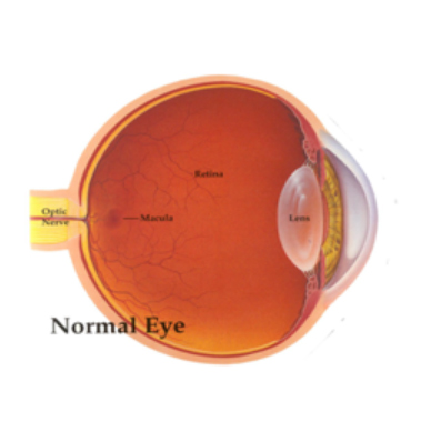 Ashfield-Eye-Clinic_Cataract_2