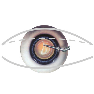 Ashfield-Eye-Clinic_Cataract_pt-2_Sm