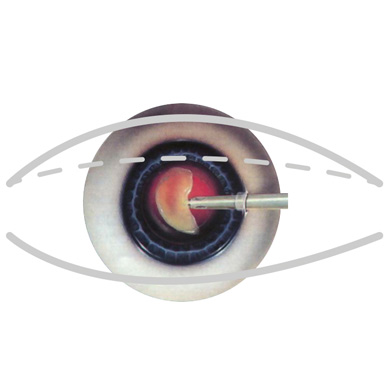 Ashfield-Eye-Clinic_Cataract_pt-3_Sm