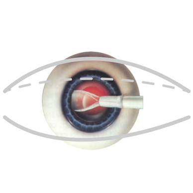 Ashfield-Eye-Clinic_Cataract_pt-4_Sm
