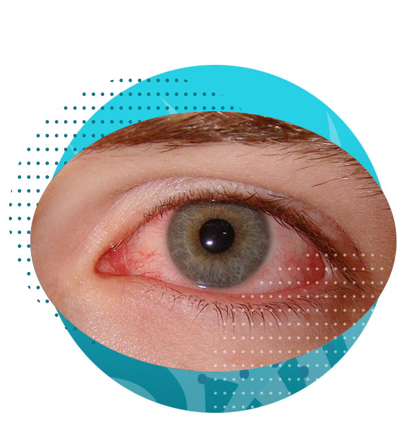 Ashfield-Eye-Clinic_Eye-Condition_Dry-Eyes